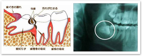 親知らずの抜歯