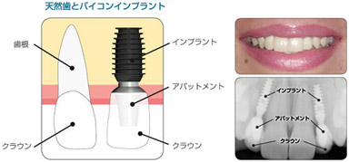 インプラント